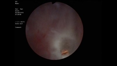 Тулиевая энуклеация аденомы простаты